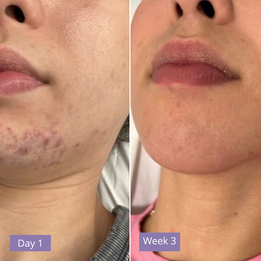 Anuae Skin Cyperus Rotundus Serum